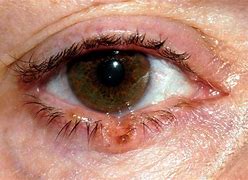 Image result for Lower Eyelid Cancer