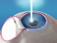 Image result for Laser Refractive Surgery