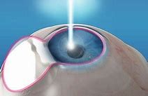 Image result for Laser Refractive Eye Surgery