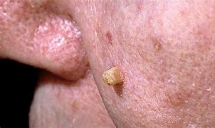 Image result for Skin Cancer Rash