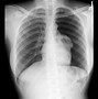 Image result for Normal Healthy Lungs