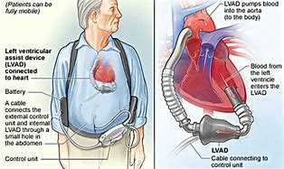Image result for Heart Pump for Baby