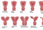 Image result for Uterus Didelphys. Size: 144 x 100. Source: www.thenursepage.com