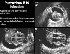 Image result for Fifth Disease Parvovirus B19