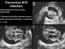 Image result for 3 Month Old Baby Parvovirus B19