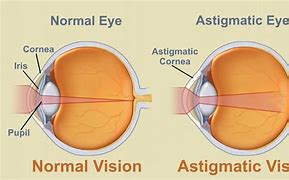 Image result for Astigmatism Signs