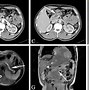 Image result for Cystic Pancreatic Tumors