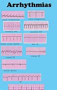 Image result for Heart Rhythm Identification Chart