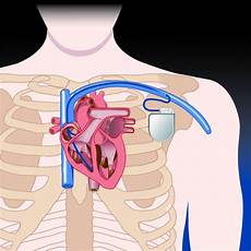 test di quando si deve l impianto di pacemaker quando si deve mettere il pacemaker test di quando si deve l impianto di pacemaker quando si deve mettere il pacemaker
