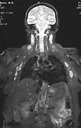 Image result for Lymphoma Swollen Lymph Nodes in Neck