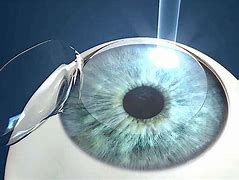 Image result for LASIK Eye