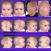 Image result for Baby with Weird Head Shape