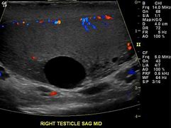 Image result for How Big Is 4 Cm Cyst