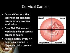 Image result for Cervical Polyp Cancer