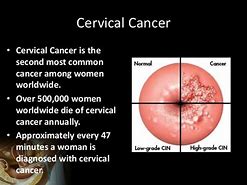 Image result for Cervical Polyp Cancer