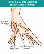 Image result for Thumb Tendon Injury