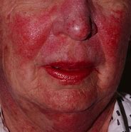 Image result for Skin Eruptions