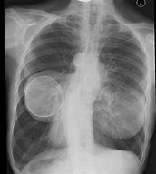 Image result for Cancer X-ray