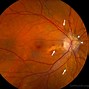 Image result for Trachomatis Eye