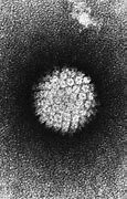 Image result for Female HPV Genital Warts