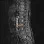 Image result for MRI Scan Lumbar Spine