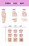 Image result for Different Types of Foot Warts