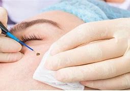 Image result for Wart Remover On Mole Before and After