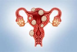 Image result for Polypoidal Uterine Fibroid