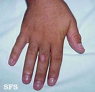 Image result for Knuckle Skin Thickening
