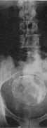 Image result for Dermoid Ovarian Cyst X-ray