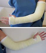 Image result for Invisible Cast Arm