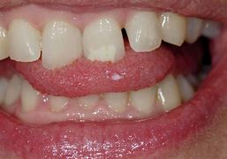 Image result for Papilloma Tongue