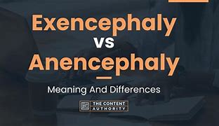 Image result for Exencephaly vs Encephalocele Radiology
