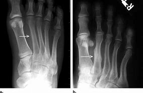Image result for March Fracture
