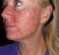 Image result for Solar Keratosis