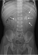 Image result for 2 Cm Kidney Stone