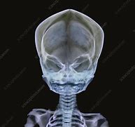 Image result for Toddler Skull