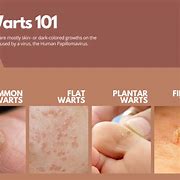 Image result for Molluscum Warts On Lip