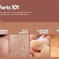 Image result for Molluscum Warts On Back of Knee