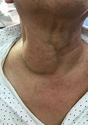 Image result for Photo of a Fat Neck Tumor
