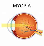 Image result for Myopia Lasik