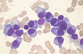 Image result for Plasma Cell Leukemia
