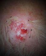 Image result for Squamous Cell Skin Cancer Scalp