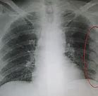 Image result for Broken Rib Meme