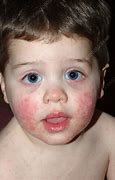 Image result for Fifth Disease Images
