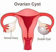 Image result for Ovarian Cysts Removed
