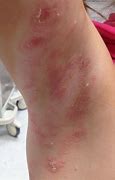 Image result for Molluscum On Arms