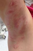 Image result for Molluscum Red and Irritated