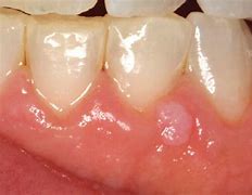 Image result for Gingival Papilloma Problems