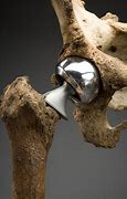 Image result for Head of Femur Replacement